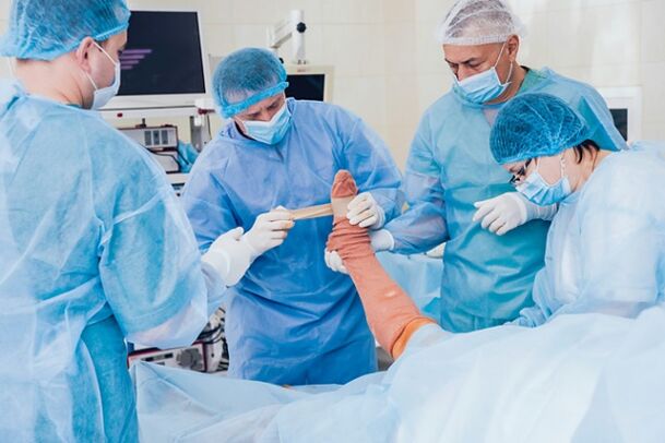 Varicosis operation