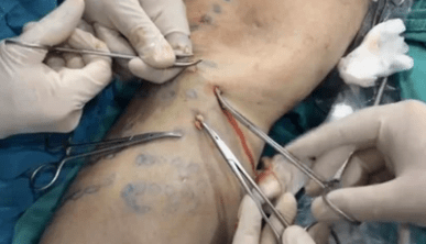 How phlebetomy is performed to remove varicose veins