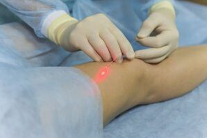 surgery for varicose veins in the legs