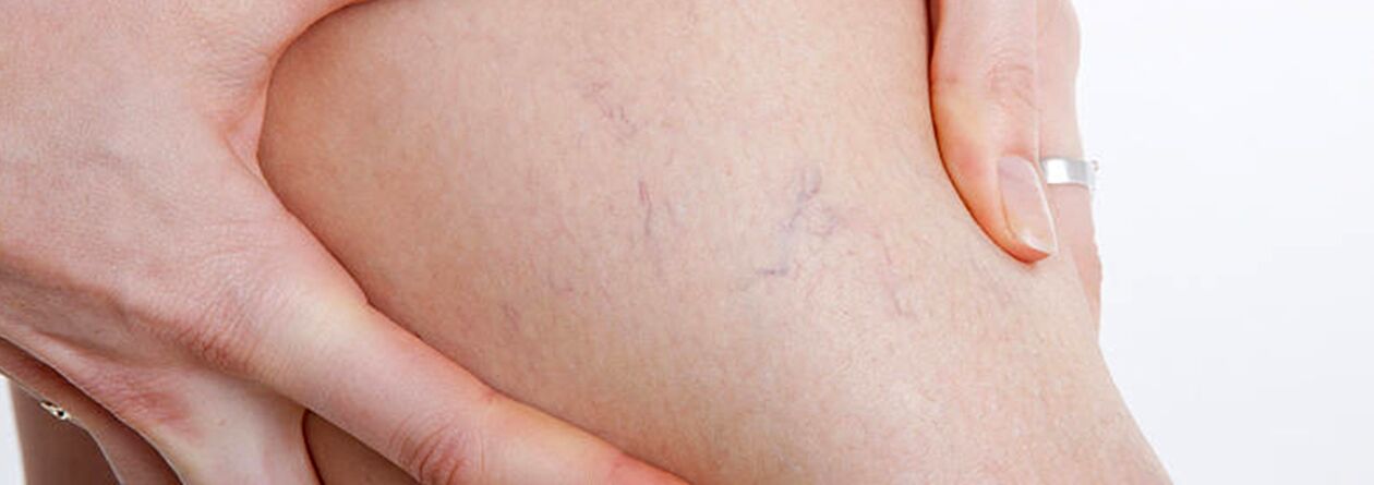 Spider veins with varicose veins