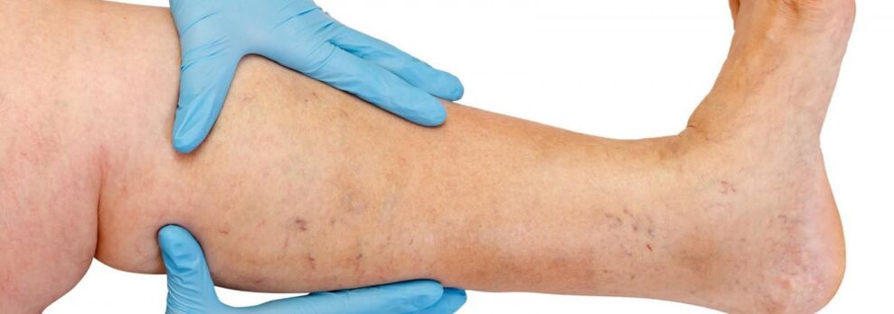 Varicose veins on the leg